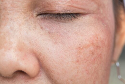 Melasma, qué es y cómo puedes prevenirlo